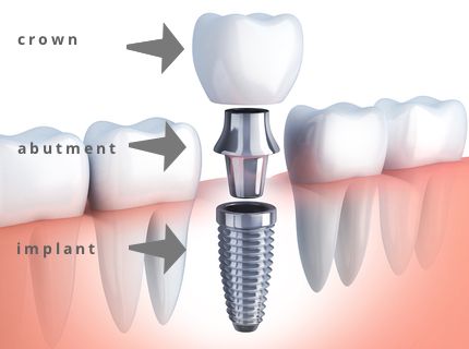 Different parts of a dental implant: crown, abutment and implant